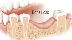 Bone Loss
